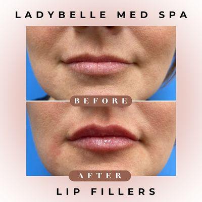 Lip enhancement with filler and Xeomin neurotoxin. Book your free consultation 714-534-4500.