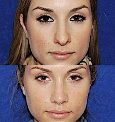 Rhinoplasty