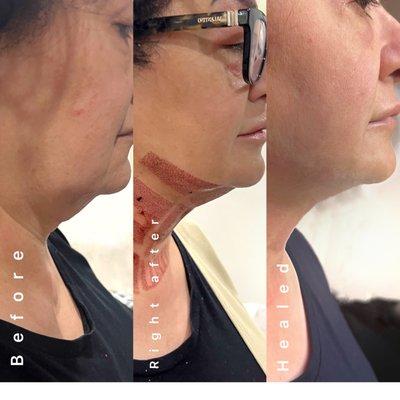 #Plasma #fibroblast skin tightening before after two weeks post