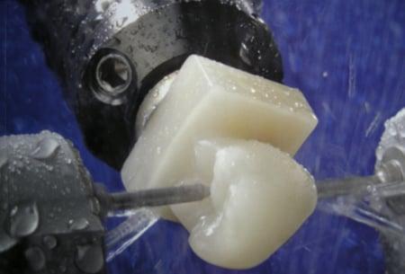 Cerec Same Day Porcelain teeth