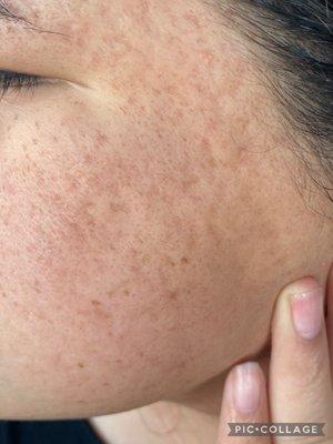 After 4 microneedling treatments