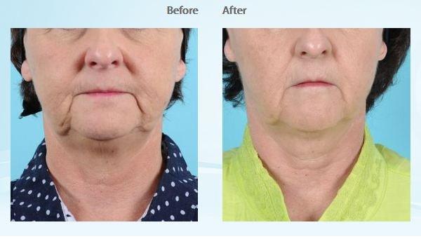 Ulthera-Patient #7080 Frontal Before & After