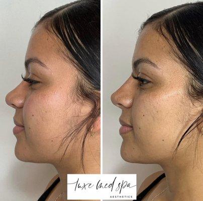 Non-Surgical Rhinoplasty (Nose Job) in Orlando, FL