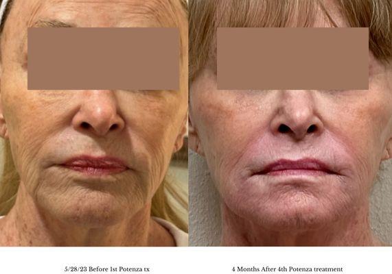 Before 1 & after a series of 4 Potenza Radio Frequency Microneedling treatments for face and neck