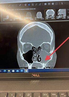 CT scan of implant through the sinus membrane and infection. Black area sinus is healthy.