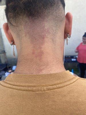 Haircut rash