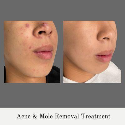 Acne & Mole Removal Treatment