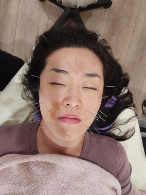 Facial acupuncture