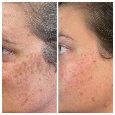 Laser sunspot/Hyperpigmentation Removal