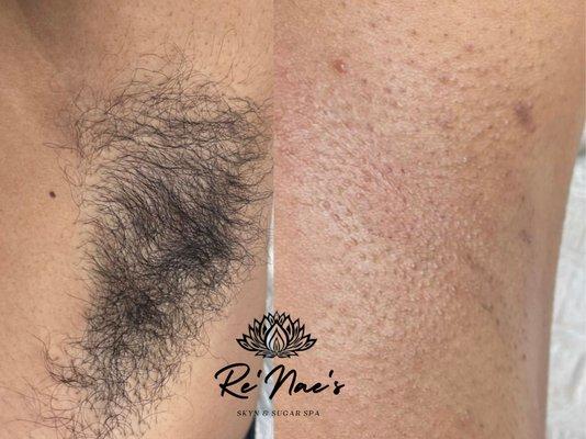 Underarm hair removal