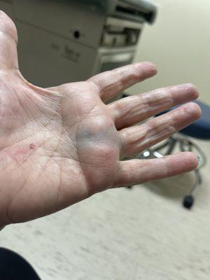 Hand injury