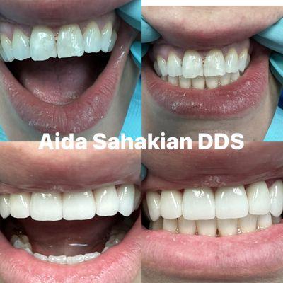 Zirconium crowns before and after pictures