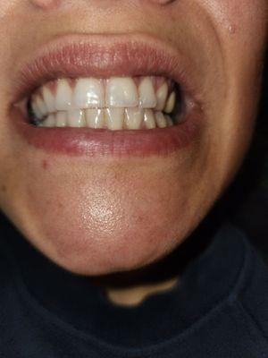 20 minute Teeth Whitening  add on Beautiful Outcome