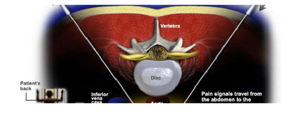 Celiac Plexus Block - A celiac plexus block procedure is performed to diagnose pain in the abdominal region that is caused by...