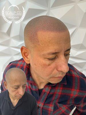 Scalp Co. Scalp Micropigmentation