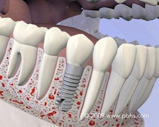 Sarasota, FL Dental Implants