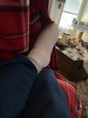 My foot wrapped up for recovery after a week and 2 days post surgery.