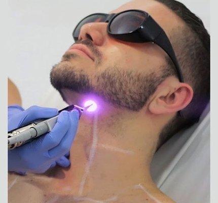 Laser Hair Removal