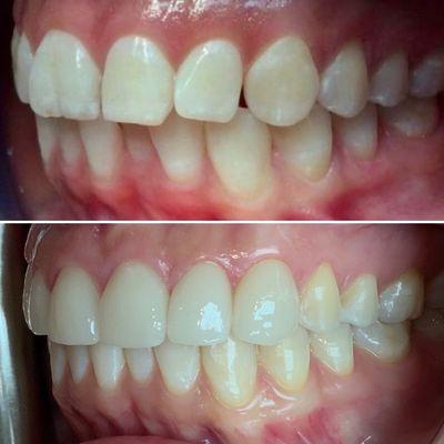 Cosmetic makeover using custom made veneers by our in-house lab