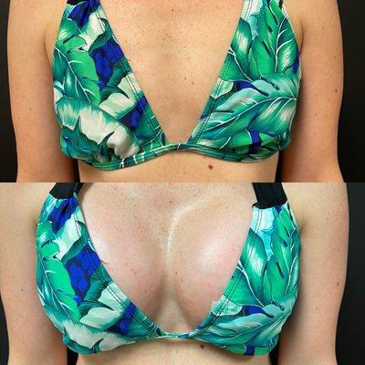 Before and after breast augmentation