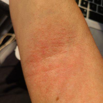 Rash from massage