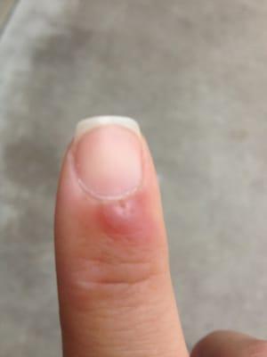 Infection caused by a cut at VIP nails a week later...