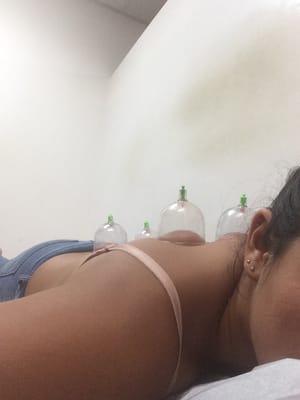 Cupping