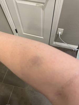 Bruise from faulty samples falling