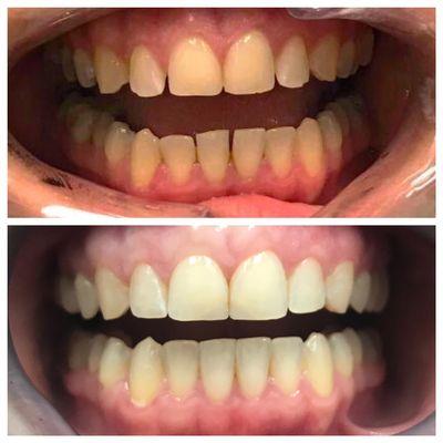 Before and after Invisalign treatment