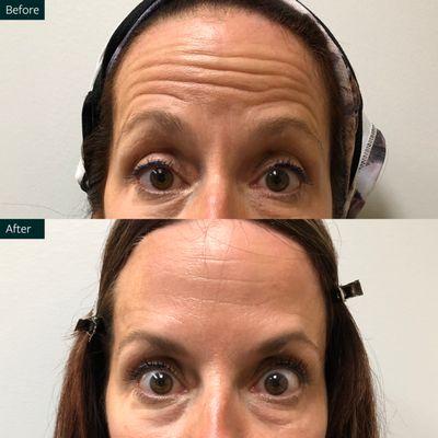 The Skin Center Before and After Botox