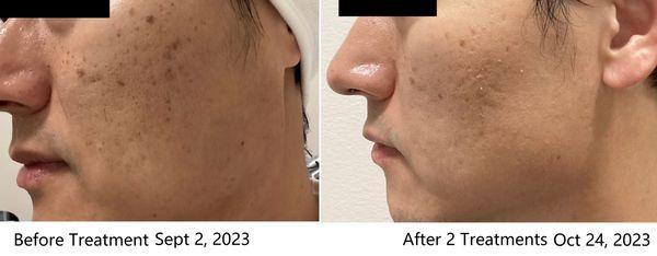 Laser skin resurfacing two treatments. It works for me!