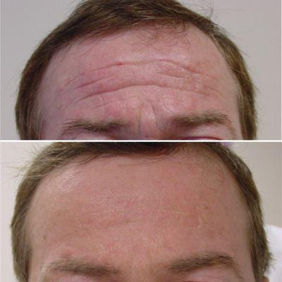 Treatment of forehead wrinkles with Botox. Note the natural position of the brow.