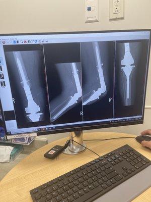 My right leg after I fell and after it was fixed