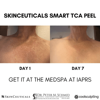 SkinCeuticals Smart TCA Peel Before After by Alithia