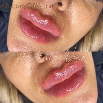 Non invasive lip filler