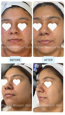 "Rachel Moayer Skin signature treatments with salt exfoliation utilizes medical-grade serums and advanced techniques