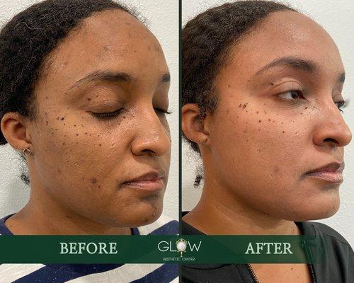 Cosmelan Peel (21 days after) Glow Aesthetic Center