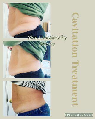 Body Cavitation