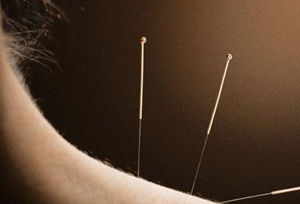 Acupuncture