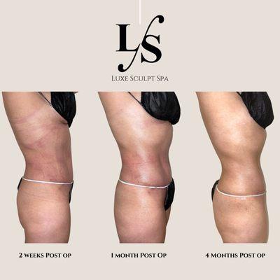 Progress Photos of our client healing from Liposuction. 2 weeks Vs1 Month Vs 4 Months