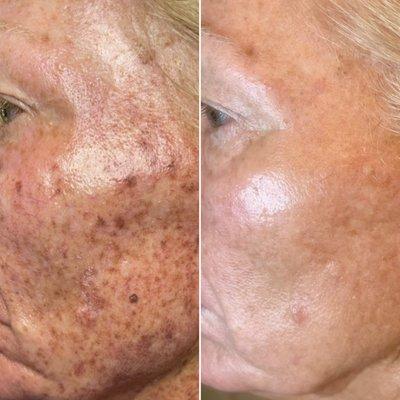 Laser Skin Rejuvenation