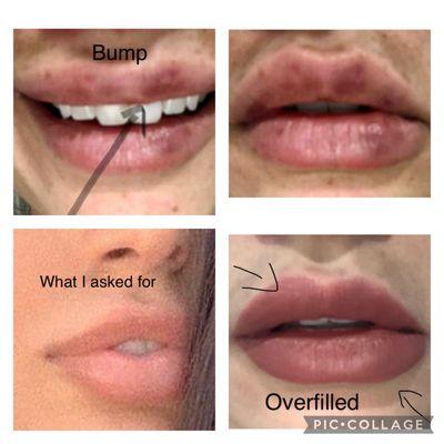 Lip filler unevenness