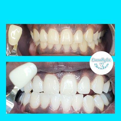 Professional Laser Teeth Whitening,  Great results in an Advanced 1-Hr Teeth Whitening session. #1 Teeth Whitening Spa, Eternally Lit Smiles