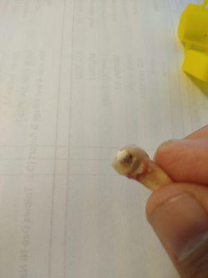 Healthy roots tooth not cleaned out properly