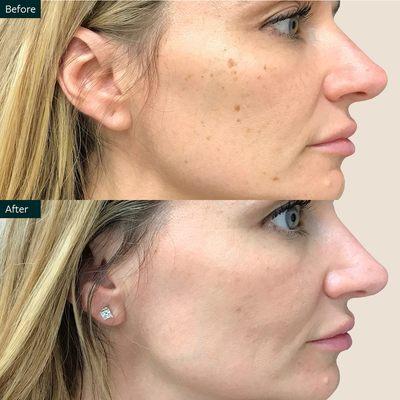 The Skin Center Before and After BBL Laser