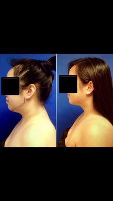 Chin liposuction