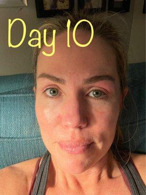 Only at day 10 and optimal results aren't until 3 months post op!