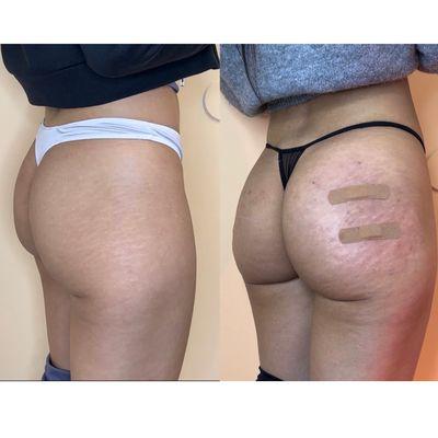 buttocks augmentation before after