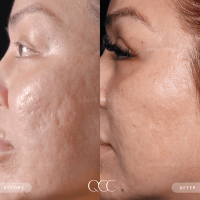 Acne Scar Treatment Results by Dr. Qazi!