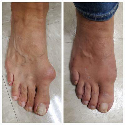 Before and after Bunion Correction minimal incision